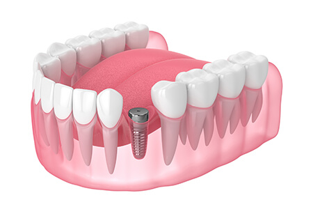 mzg-implantologie-450x300