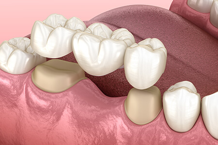 mzg-kroon--brugwerk450x300